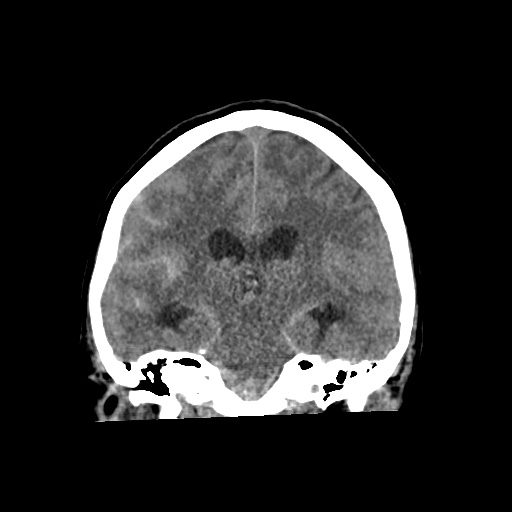 Aneursym related subarachnoid hemorrhage with hydrocephalus (Radiopaedia 45105-49083 Coronal non-contrast 37).jpg