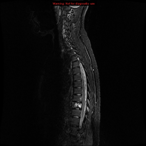 File:Aneurysmal bone cyst (Radiopaedia 9419-10103 Sagittal T2 3).jpg