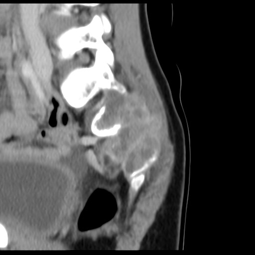 File:Aneurysmal bone cyst - sacrum (Radiopaedia 65190-74195 A 23).jpg