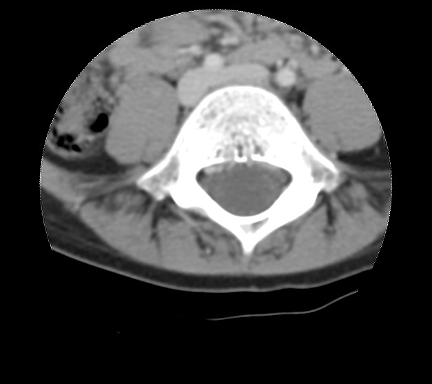 Aneurysmal bone cyst - sacrum (Radiopaedia 65190-74195 Axial non-contrast 9).jpg