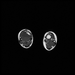 File:Aneurysmal bone cyst - tibia (Radiopaedia 22343-22367 Axial T1 12).jpg