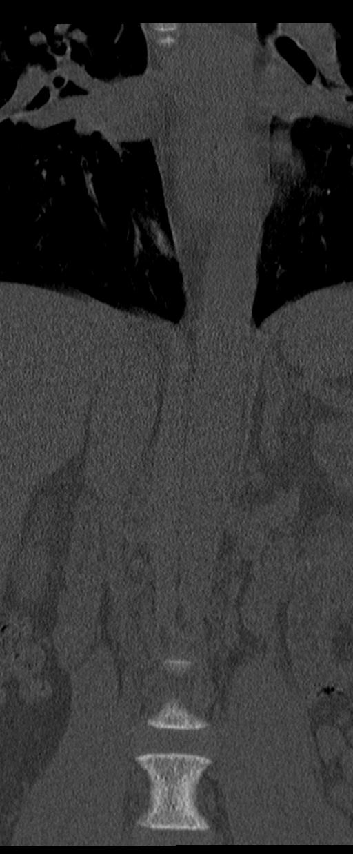 Aneurysmal bone cyst T11 (Radiopaedia 29294-29721 Coronal bone window 10).jpg