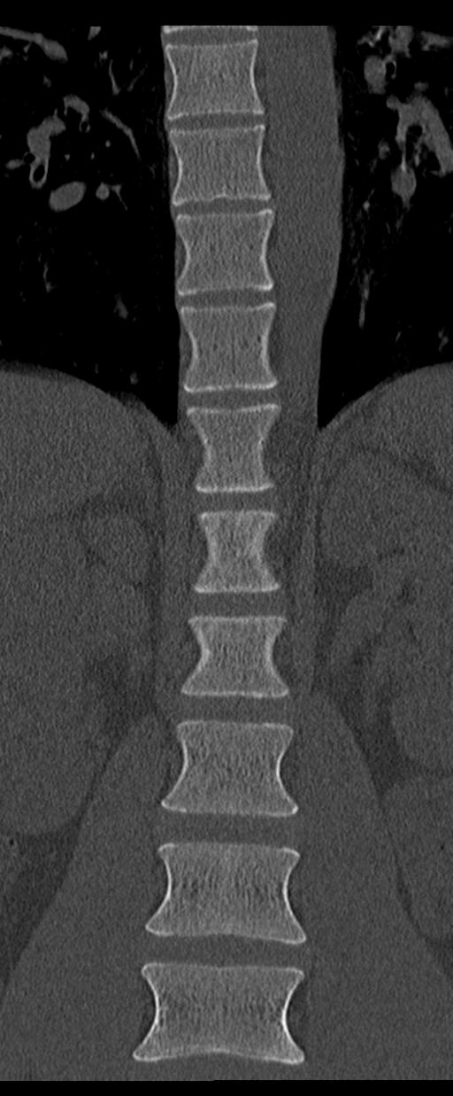 Aneurysmal bone cyst T11 (Radiopaedia 29294-29721 Coronal bone window 19).jpg