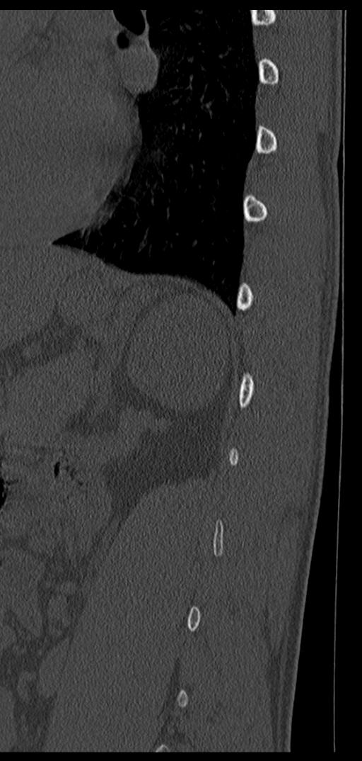 Aneurysmal bone cyst T11 (Radiopaedia 29294-29721 Sagittal bone window 14).jpg