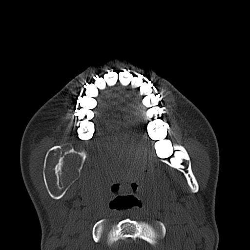 Aneurysmal bone cyst of the mandible (Radiopaedia 43280-46601 Axial bone window 34).jpg