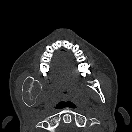 File:Aneurysmal bone cyst of the mandible (Radiopaedia 43280-46601 Axial bone window 41).jpg