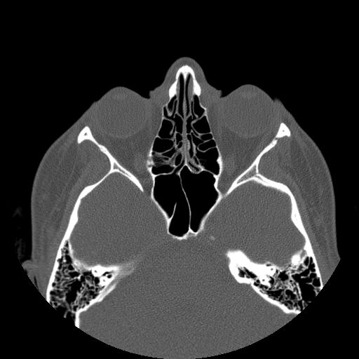 Aneurysmal bone cyst of the mandible (Radiopaedia 43280-46823 Axial bone window 165).jpg