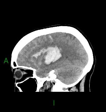 File:Aneurysmal subarachnoid hemorrhage with intra-axial extension (Radiopaedia 84371-99699 B 16).jpg