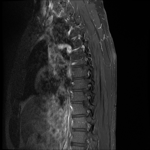 File:Angiolipoma - thoracic spine (Radiopaedia 28242-28479 E 12).jpg