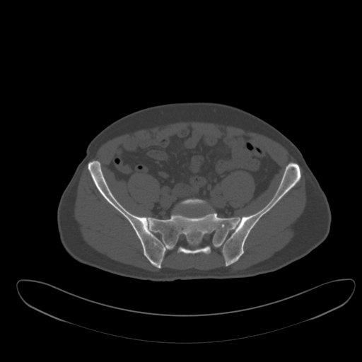 Ankylosing spondylitis (Radiopaedia 52728-58645 Axial bone window 18).jpg