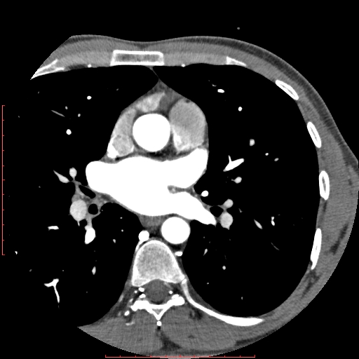 Anomalous left coronary artery from the pulmonary artery (ALCAPA) (Radiopaedia 70148-80181 A 70).jpg