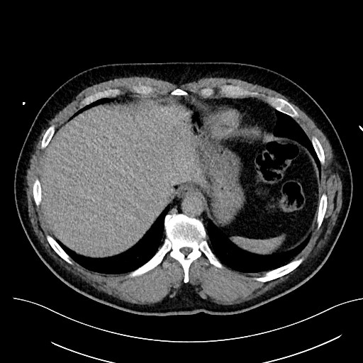 File:Anomalous origin of the left coronary artery with malignant course (Radiopaedia 77842-90126 Axial non-contrast 29).jpeg