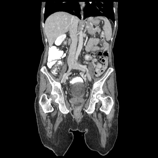 File:Anorectal carcinoma (Radiopaedia 44413-48064 B 44).jpg