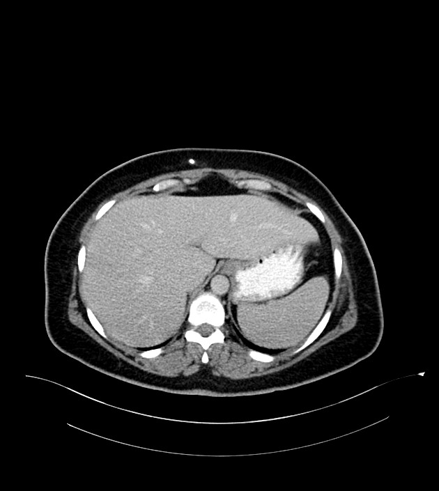 Anterior abdominal wall CSF pseudocyst (CSFoma) (Radiopaedia 79453-92571 A 21).jpg
