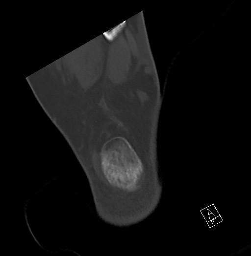 File:Anterior calcaneal process fracture (Radiopaedia 63353-71943 Axial bone window 121).jpg