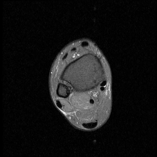 File:Anterior calcaneal process fracture (Radiopaedia 71377-81705 Axial PD fat sat 1).jpg