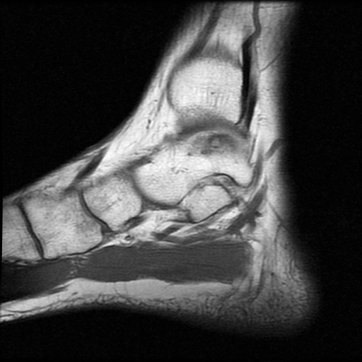 File:Anterior calcaneal process fracture (Radiopaedia 74654-85611 Sagittal T1 5).jpg