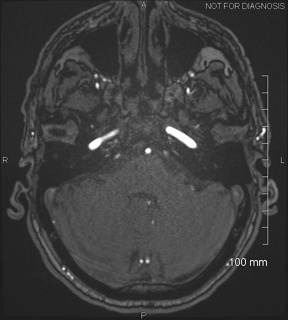 Anterior cerebral artery aneurysm (Radiopaedia 80683-94127 Axial MRA 49).jpg