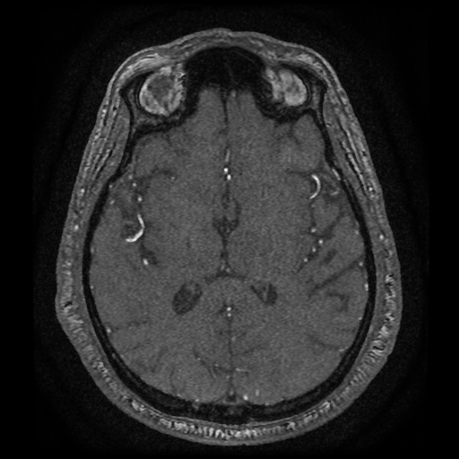 Anterior cerebral artery infarction (Radiopaedia 46794-51323 Axial MRA 116).jpg
