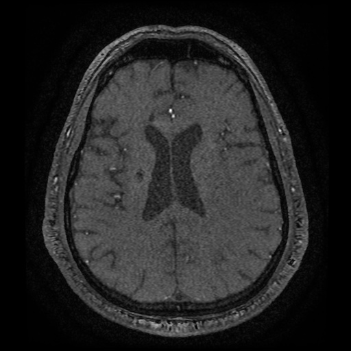 Anterior cerebral artery infarction (Radiopaedia 46794-51323 Axial MRA 141).jpg