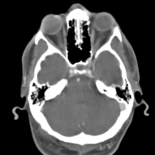 Anterior cerebral artery territory infarct (Radiopaedia 39327-41581 B 42).png