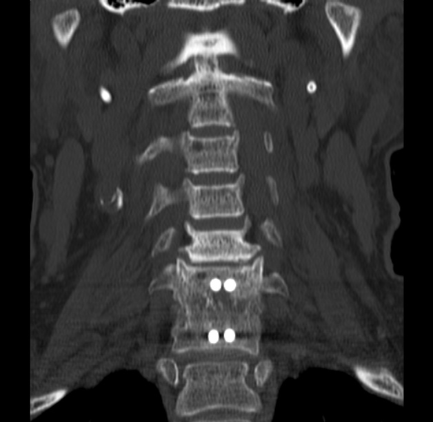 Anterior cervical postdiscectomy arthrodesis (Radiopaedia 32678-33646 Coronal bone window 19).jpg