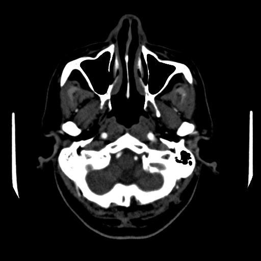 File:Anterior communicating artery aneurysm (Radiopaedia 16633-16335 A 3).jpg