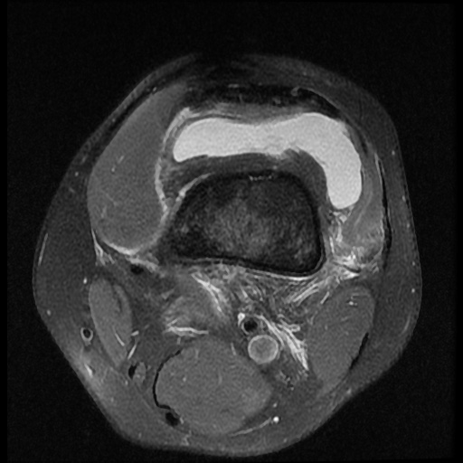 File:Anterior cruciate ligament tear (Radiopaedia 61500-69462 Axial PD fat sat 1).jpg