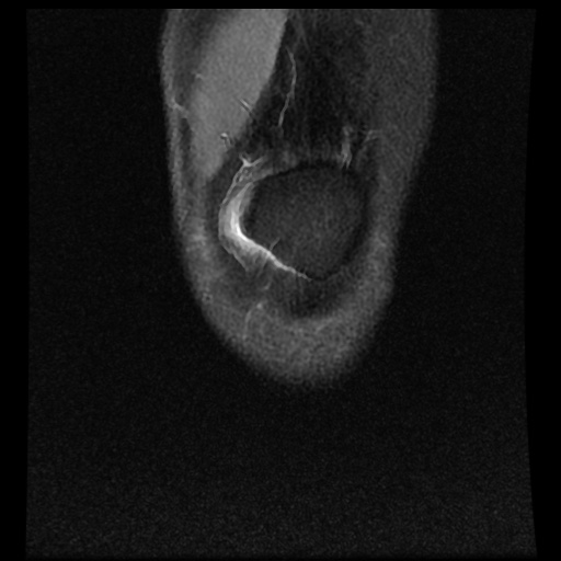 File:Anterior cruciate ligament tear (Radiopaedia 61500-69462 Coronal PD fat sat 1).jpg