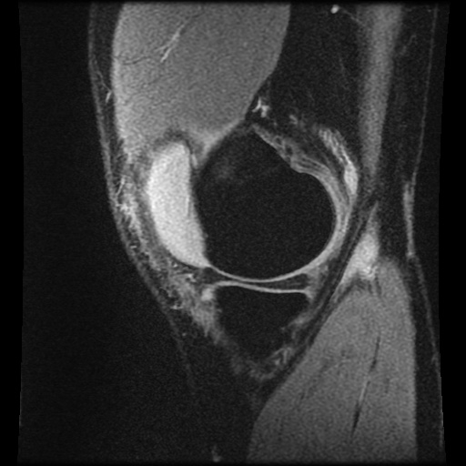 File:Anterior cruciate ligament tear (Radiopaedia 61500-69462 F 13).jpg