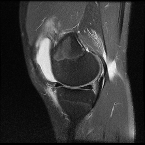 File:Anterior cruciate ligament tear (Radiopaedia 61500-69462 Sagittal PD fat sat 5).jpg