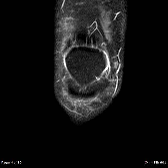 File:Anterior cruciate ligament tear (Radiopaedia 70783-80964 Coronal STIR 4).jpg