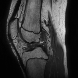 File:Anterior cruciate ligament tear - pediatric (Radiopaedia 62152-70260 Sagittal PD 95).jpg