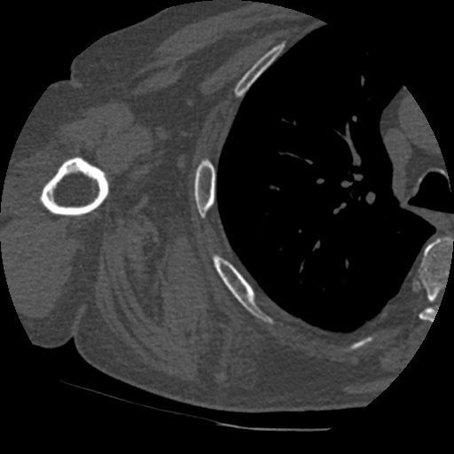Anterior glenohumeral dislocation with Hill-Sachs lesion (Radiopaedia 62877-71249 Axial bone window 75).jpg