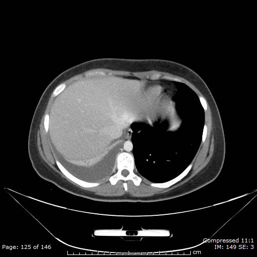 Anterior mediastinal B cell Lymphoma (Radiopaedia 50677-56114 A 63).jpg