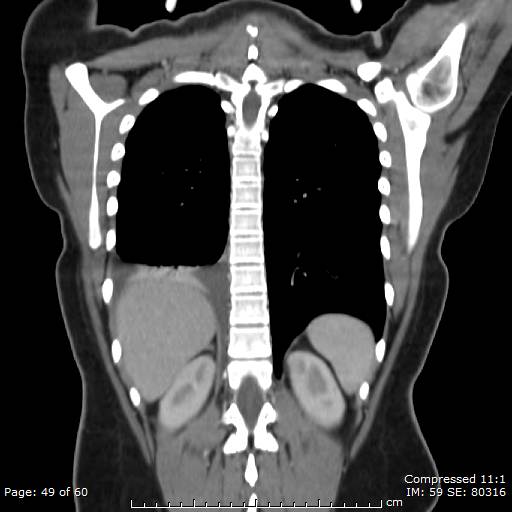File:Anterior mediastinal B cell Lymphoma (Radiopaedia 50677-56114 B 25).jpg