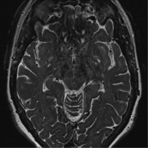 Anterior temporal pole cysts (Radiopaedia 46629-51102 Axial 60).png