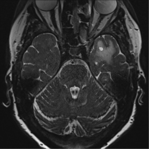 Anterior temporal pole cysts (Radiopaedia 46629-51102 Axial T2 56).png