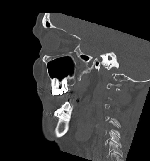 Anterior temporomandibular joint dislocation (Radiopaedia 59430-66784 B 19).jpg