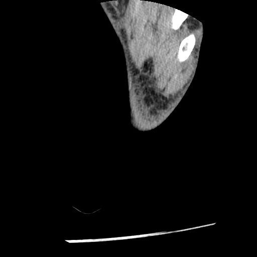Anterior tibial artery false aneurysm (Radiopaedia 88984-105809 A 262).jpg
