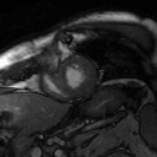 File:Anteroseptal hypokinesia after myocardial infarction (Radiopaedia 15978-15633 Short axis SSFE 11).jpg