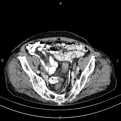 File:Aortic aneurysm and Lemmel syndrome (Radiopaedia 86499-102554 A 64).jpg