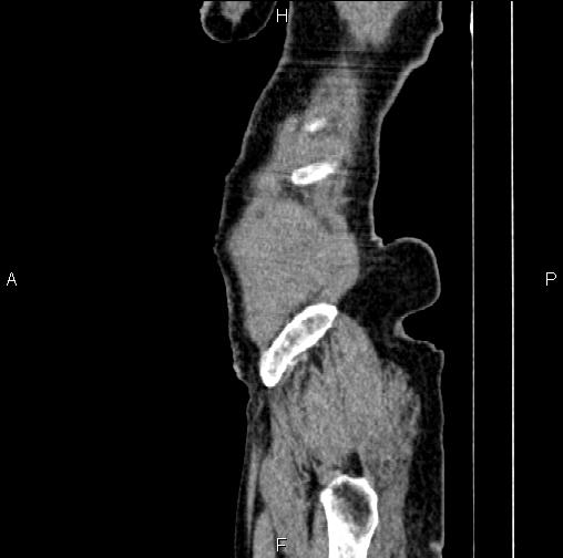 Aortic aneurysm and Lemmel syndrome (Radiopaedia 86499-102554 D 89).jpg