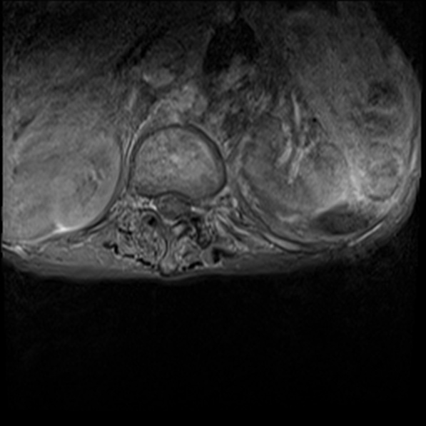 File:Aortic aneurysm with spinal destruction (Radiopaedia 42301-45409 Axial T1 fat sat 1).jpg