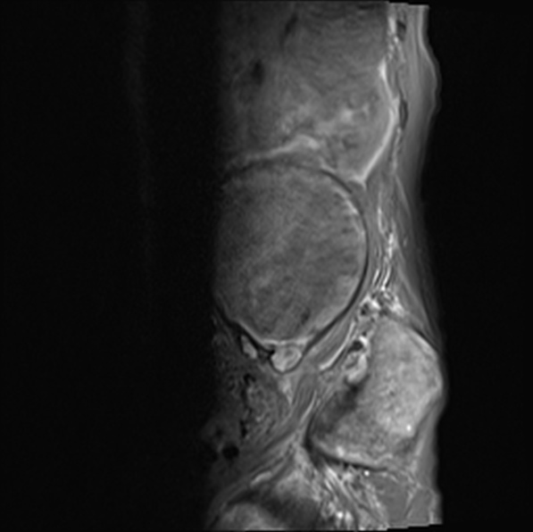 File:Aortic aneurysm with spinal destruction (Radiopaedia 42301-45409 Sagittal T1 fat sat 12).jpg