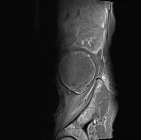 File:Aortic aneurysm with spinal destruction (Radiopaedia 42301-45409 Sagittal T1 fat sat 9).jpg