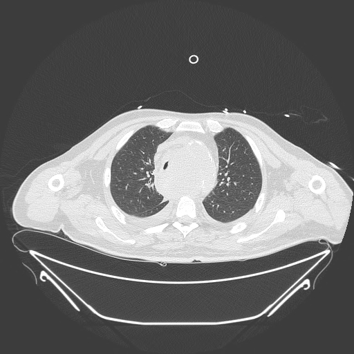 Aortic arch aneurysm (Radiopaedia 84109-99365 Axial lung window 95).jpg