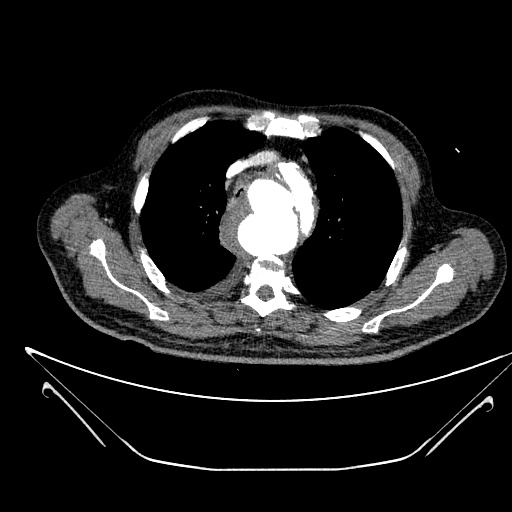 Aortic arch aneurysm (Radiopaedia 84109-99365 B 188).jpg