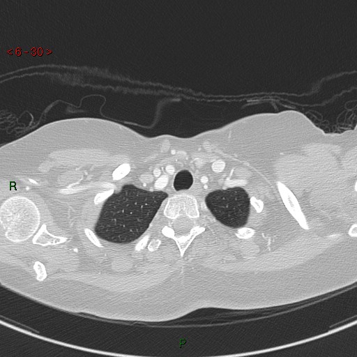 Aortic arch origin of left vertebral artery (Radiopaedia 51520-57286 Axial lung window 30).jpg