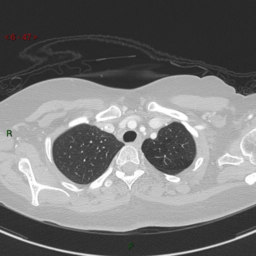 File:Aortic arch origin of left vertebral artery (Radiopaedia 51520-57286 Axial lung window 47).jpg